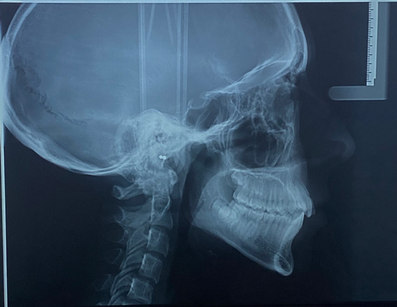 Qu’est-ce qu’une téléradiographie latérale du crâne et pourquoi en a-t-on besoin chez l’orthodontiste ?